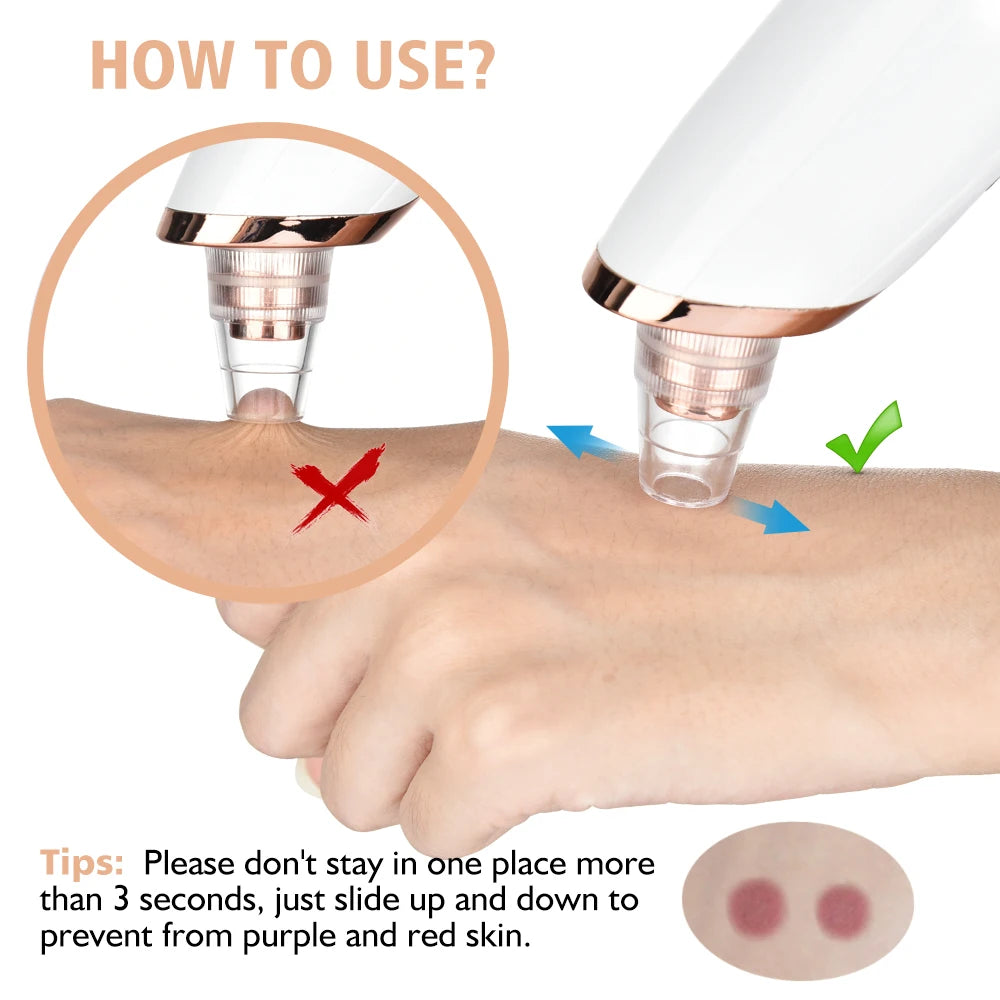 electric black head remover